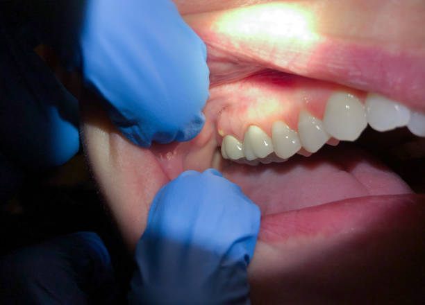 Best Lost Filling or Crown Replacement in Fellsburg, PA